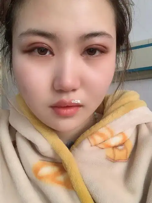 双眼皮术后第二天和第二十天