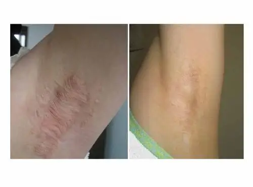 网友口述沁香微创腋臭去除术的成功案例