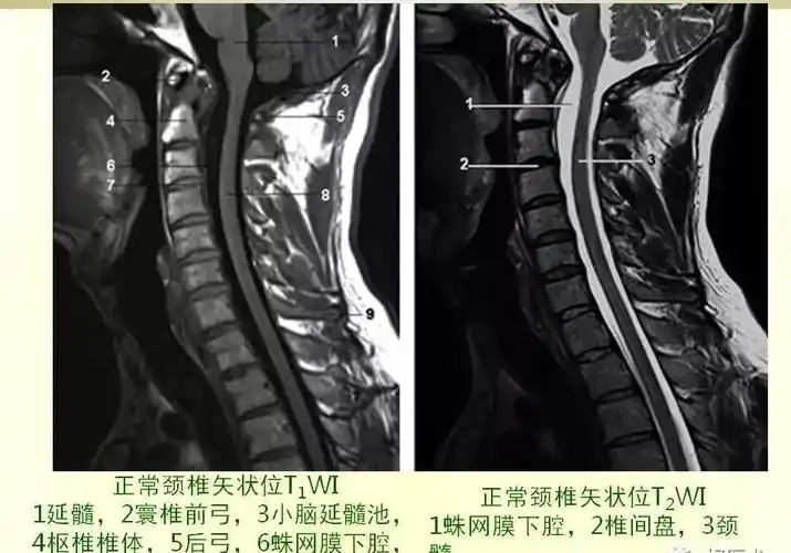 颈椎病拍了片子却一头雾水看不懂收藏起来