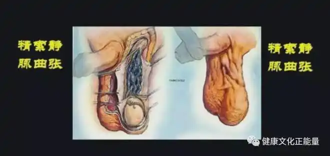 从中医的视点讲精索静脉曲张关于精液影响大不大