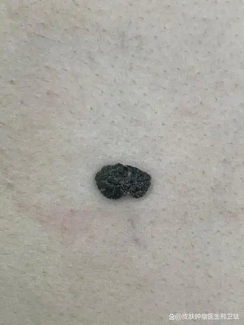 容易误诊为色素痣的脂溢性角化病