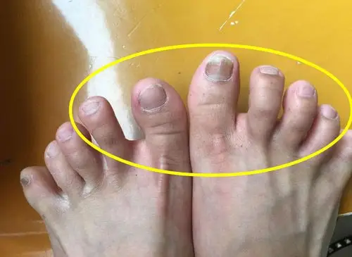 无论男女,一旦脚趾出现这3种变化,说明体内已经有癌细胞了