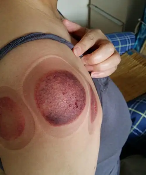 拔罐治肩周炎水去血来