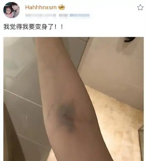 著名女星鞠婧祎晒膝盖受伤照,双膝淤青可见,说自己要打好多工