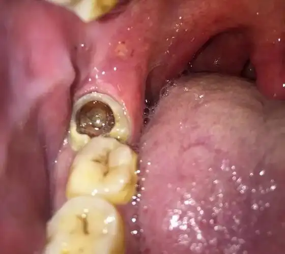 牙医遇见最烂的牙齿到底有多烂?