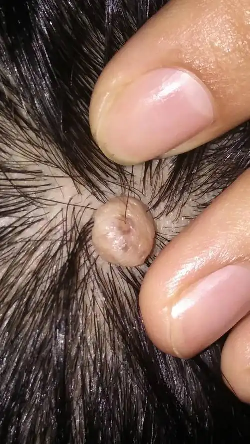 头皮上长了一个肉包,不痛不痒,已经好几年了没管它,好像长大了一点.