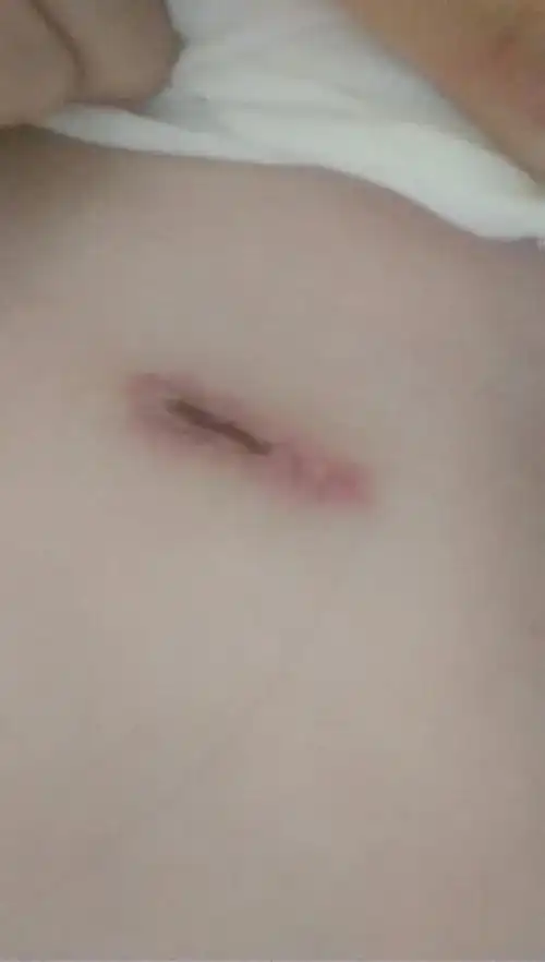 肋骨隆鼻术后,胸部伤口不愈合,鼻小柱切口往上溃烂出一个洞,能看见