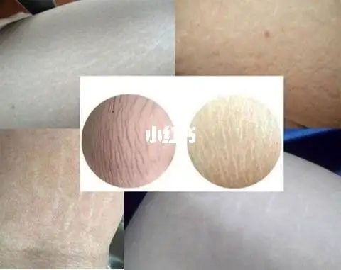 不要在分不清这两个纹路啦_肥胖纹_运动_排毒_妊娠纹_内分泌_舞蹈