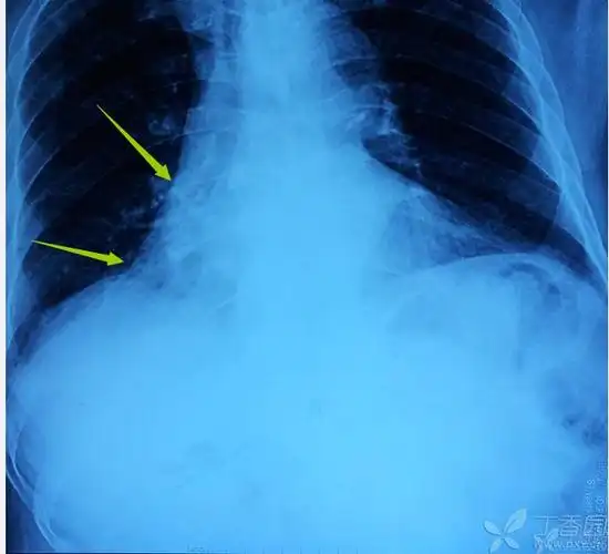 注意右侧心膈角,右下叶不张  的诊断成立.影像科的大夫会看图说话