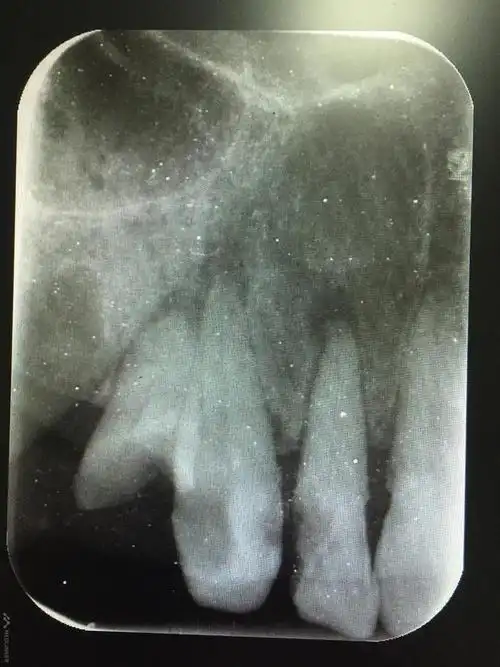 12牙14牙慢性根尖周炎