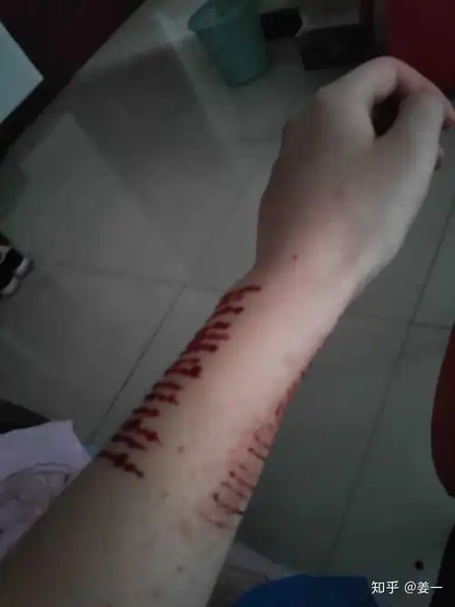 自残的人真的很令人讨厌吗?