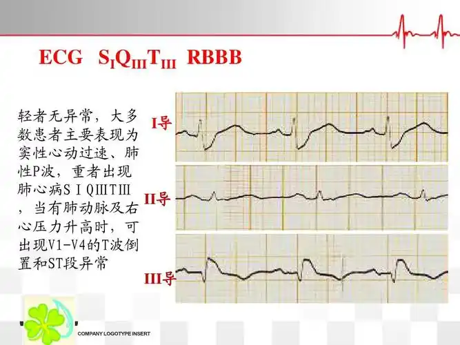 肺栓塞诊疗及护理ppt