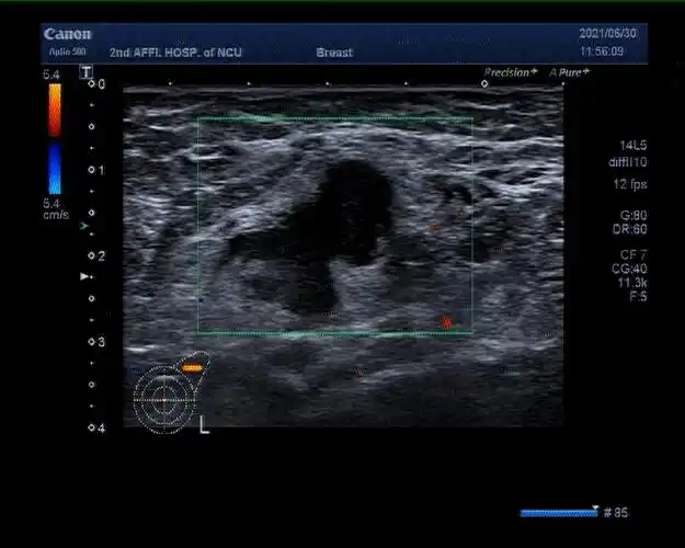 异曲同优还看今朝一例汉曲优联合帕妥珠单抗治疗her2阳性乳腺癌患者术