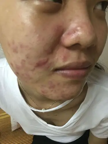 脸上长痘痘,好严重,用过好多产品都好不了,饮食也没吃上过的东西,感觉