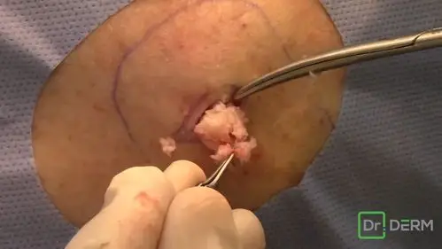 陈敏娇love         挤粉瘤,勤奋的蚊蚊.(  网页链接)