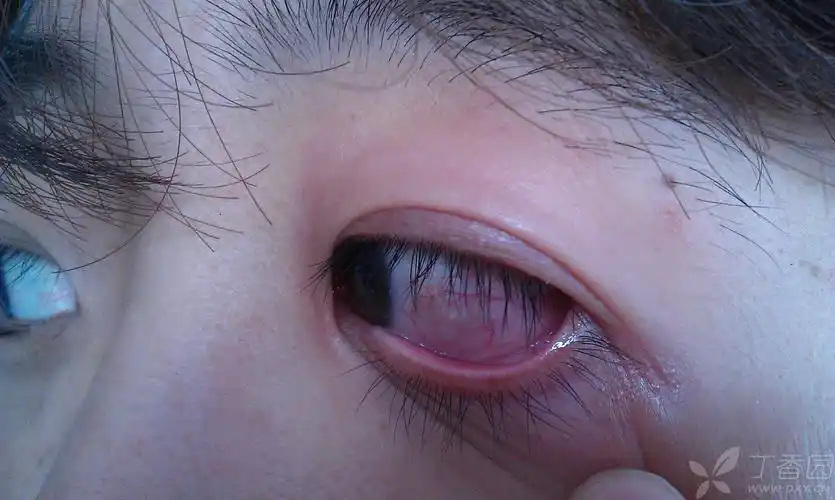 【求助】眼睛有异物感,表明不平,能推出一层透明的膜图片求助