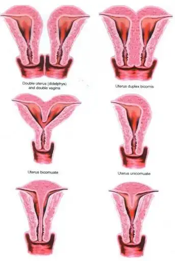 子宫畸形是咋回事?能治么?