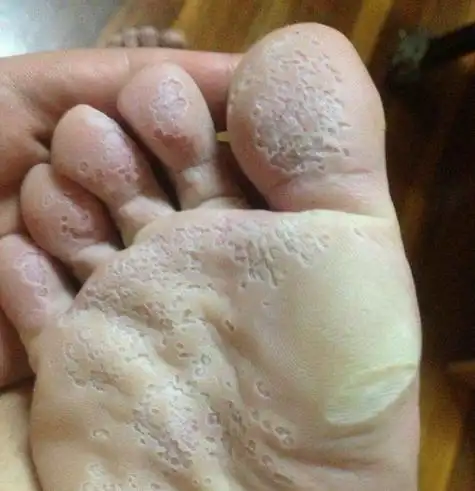 体内有癌,脚先知!出现这1异常,莫忽视!