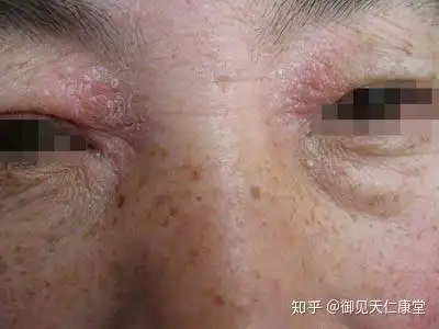 上眼皮痒红皱巴巴的有同款吗