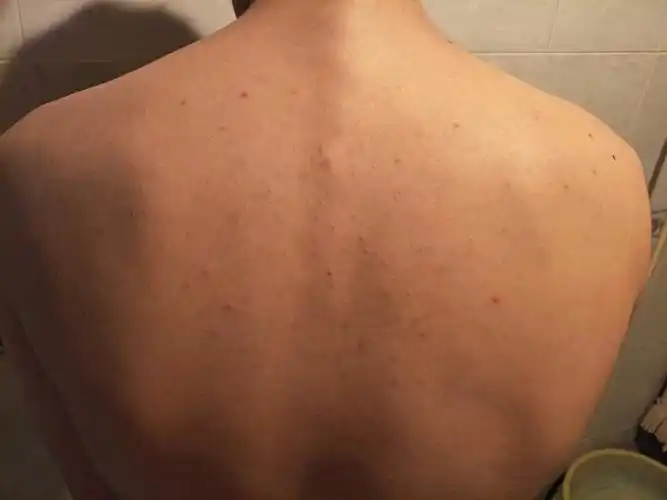 后背起了好多小痘痘这是什么病