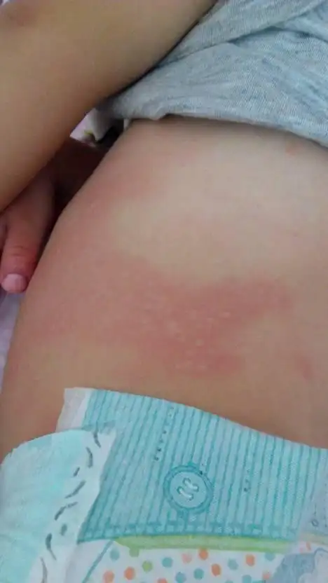 一岁半宝宝一到晚上就长这些疙瘩四肢肚子都是,痒的难受睡不好总是哭