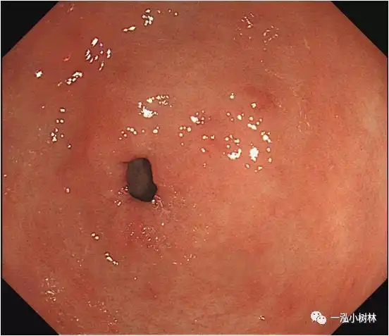 一例早期胃癌病例分享