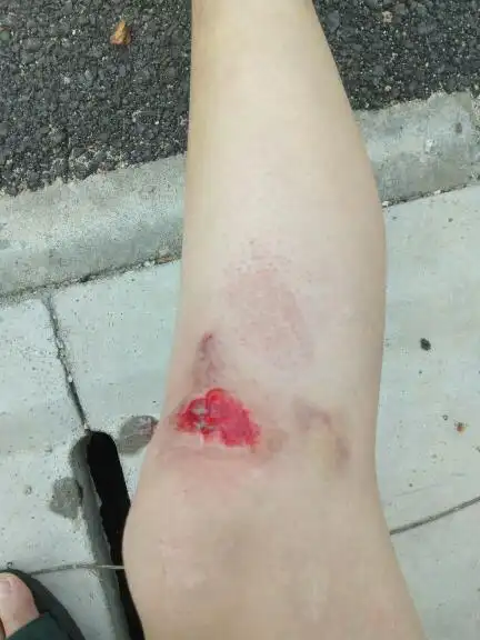 我这膝盖擦伤是不是严重了