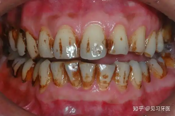 牙齿美白会不会伤牙齿?