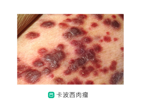 艾滋病第一次出现时竟是这个样子的可怕