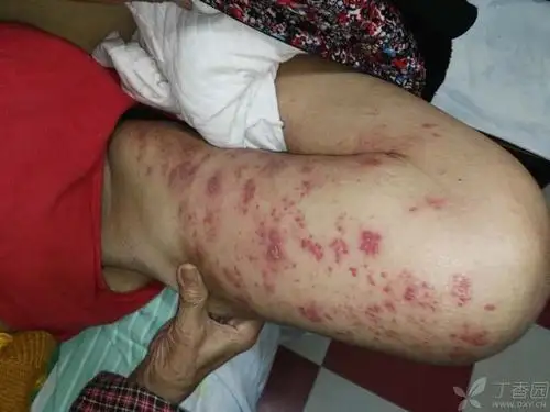 2017-02-05 21:28   关注      本人家中老人,换肺癌许久,近期长了