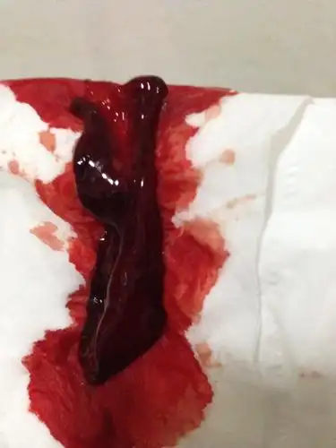 孕38天,最近四五天感冒咳嗽较重,一直有点点咖啡色分沁物,一直在家