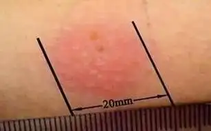 ppd皮试结果呈阳性结核阴性结核