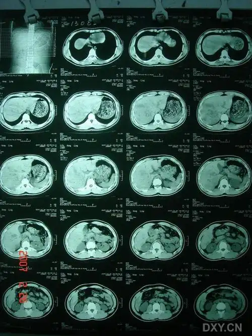 【讨论】外伤性肝破裂出血术后发现合并中央型肝破裂