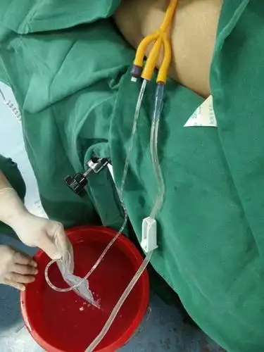 膀胱冲洗健康宣教