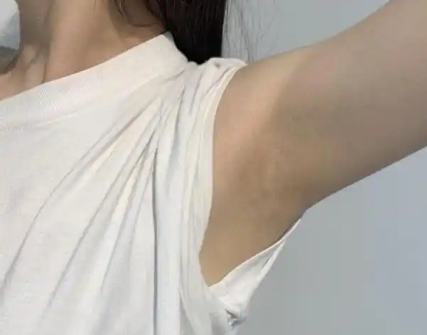 为什么有的女生腋毛旺盛,有的却很干净?腋毛多说明了什么?