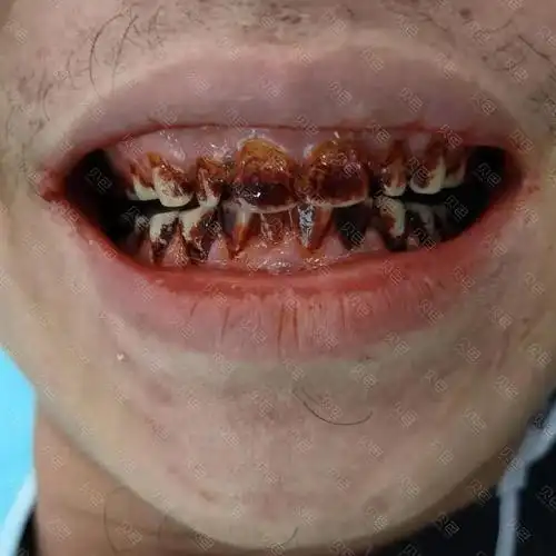 【槟榔牙喷砂洁牙】对比案例