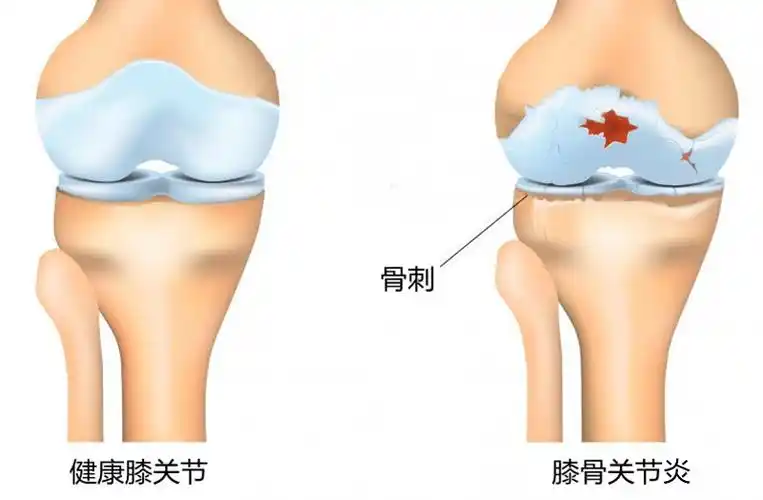 膝盖里发现有骨刺,它究竟是什么东西,有害吗?