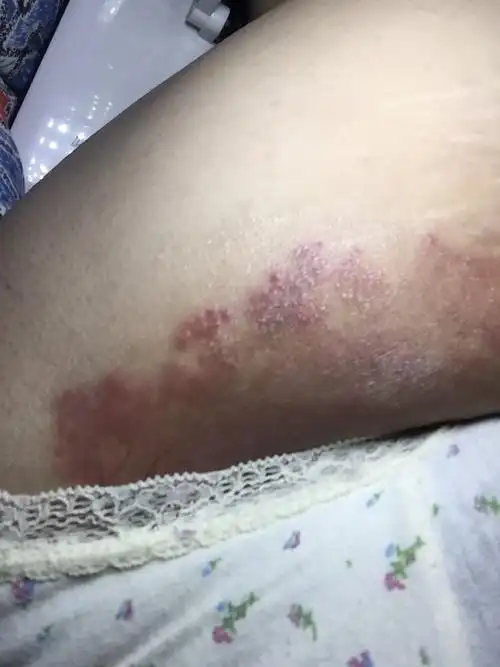 你好林医生我大腿内侧根部得了股藓擦了药但是一直不见好