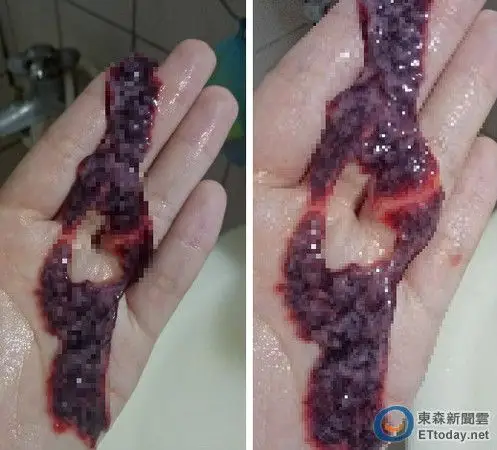 竟是「子宫内膜」流出来!