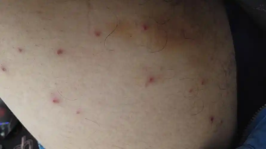 近期突然裆部瘙痒长小豆豆皮肤发黑仅限于裆部两侧