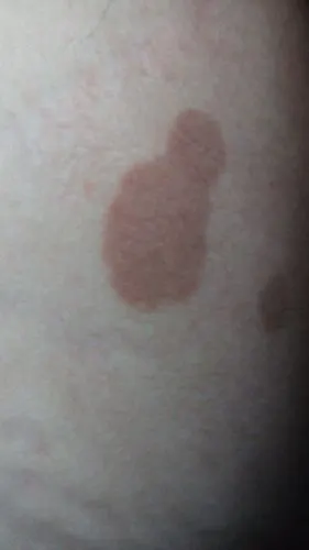 大腿内侧两边长了几块不均匀的斑块,外观呈淡紫红色,不痛不痒,_皮肤科