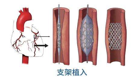 冠状动脉造影及支架植入介绍