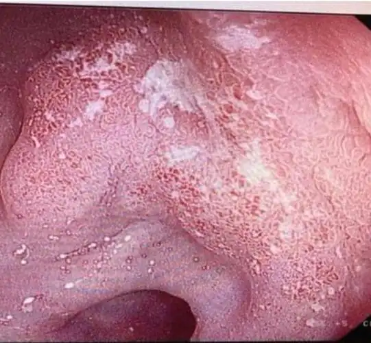 实拍图慎入|消化科医生说:胃溃疡如何预防和治疗?_保养