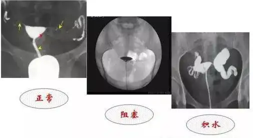 教你如何看懂输卵管堵塞粘连积水造影片子