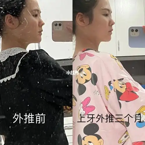 瘪嘴外推一个毫米不多不少