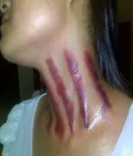 扭痧图册_百度百科