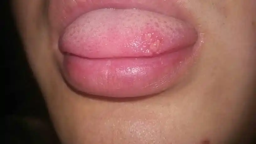 上火舌头烂了怎么办