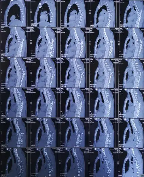 胸椎三维ct,可见患者胸6椎体粉碎骨折,椎体前半为于胸7椎体前方,使术