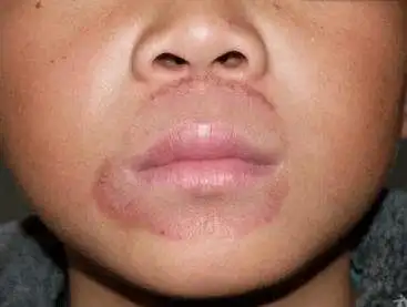 小心唇周疾病找上门_嘴唇_局部_皮肤