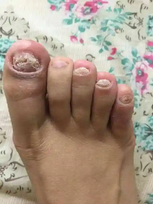 灰指甲学名甲癣,是由真菌感染所引起的一类手足情况,具有传染性.